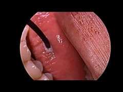 Máy phát plasma tần số vô tuyến điều trị ngáy với đầu dò đa chức năng