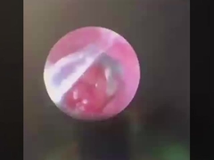 ButterFly ENT Chất liệu phẫu thuật ENT