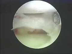 Dụng cụ phẫu thuật điện Hệ thống cắt bỏ Sản phẩm cắt bỏ cho cột sống và khớp