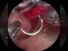 Công nghệ mát mẻ Phẫu thuật điện cực Plasma cho các thủ tục BPH