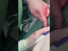 Thử nghiệm bệnh gan PLA408 cho phẫu thuật mở